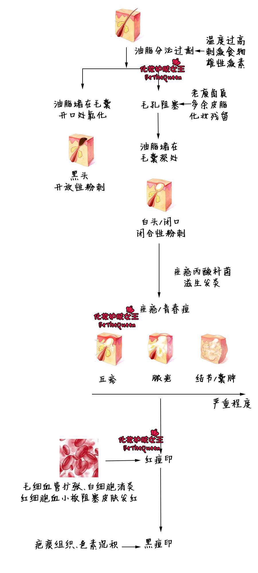 长痘了怎么快速消除痘印,频繁长痘怎么去痘印小妙招