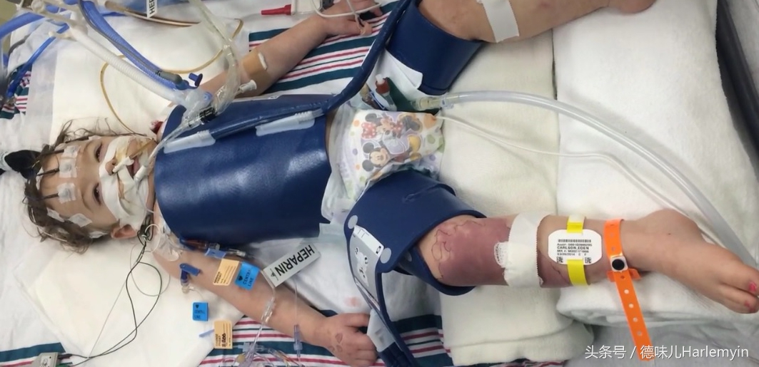 儿童溺水后缺氧性脑损伤案例,小孩溺水致脑死亡还有救吗