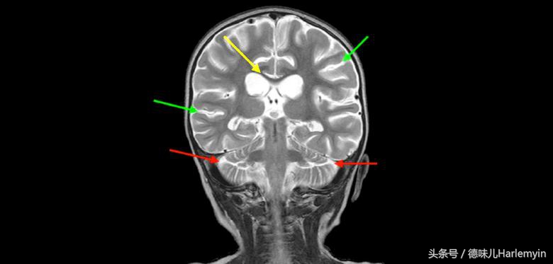 儿童溺水后缺氧性脑损伤案例,小孩溺水致脑死亡还有救吗