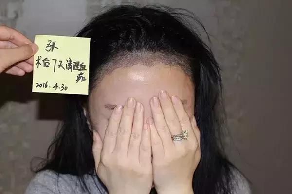 做了发际线还会长吗,做了发际线头型是不是比较好看