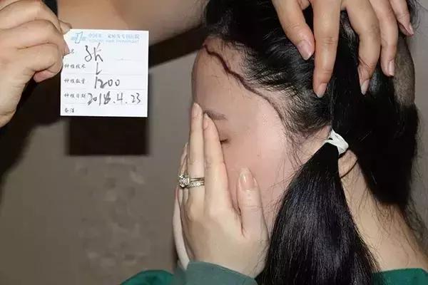 做了发际线还会长吗,做了发际线头型是不是比较好看