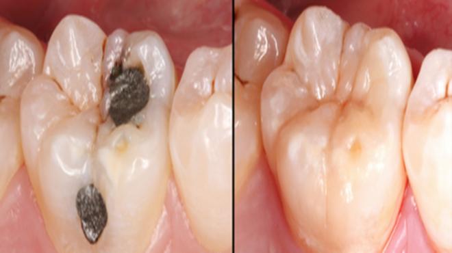 牙齿有大黑洞又痛怎么办,牙齿有黑洞很疼怎么办