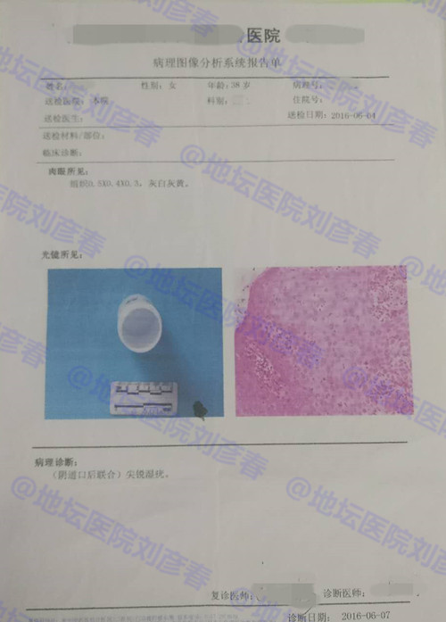 hpv病例分享,高危型hpv31阳性湿疣怎么治疗