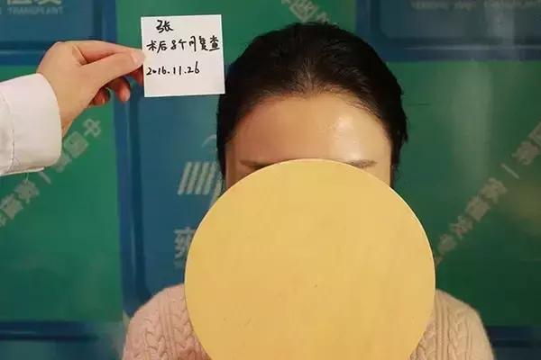 做了发际线还会长吗,做了发际线头型是不是比较好看