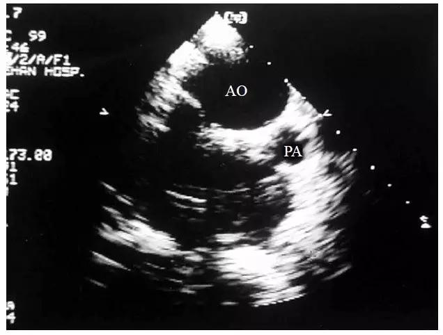超声肺动脉瓣示意图,肺动脉左右分支超声视频