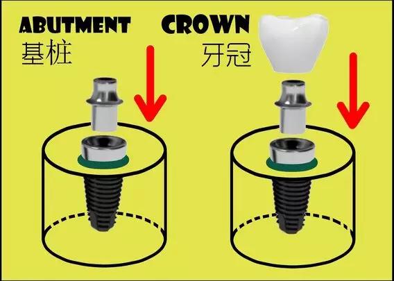 种植牙科普漫画,种植牙漫画素材