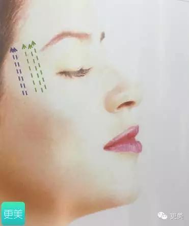 脸部缝美容线好还是普通线好,医院埋线和美容院埋线有什么差别