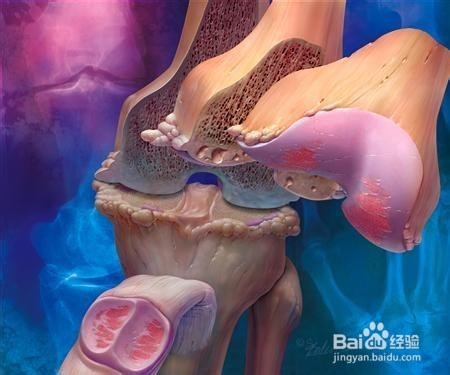 美国骨科协会氨糖,世界卫生组织治疗骨刺