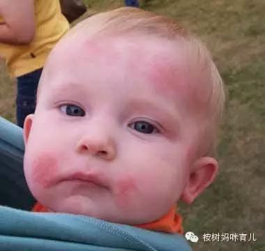 宝宝湿疹宝妈怎么祛湿,宝宝湿疹拿什么药泡澡