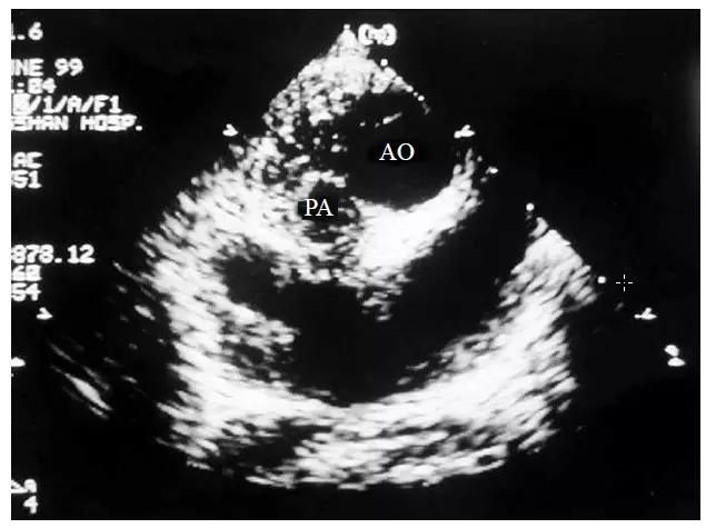 超声肺动脉瓣示意图,肺动脉左右分支超声视频