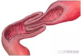 一岁宝宝受惊吓会造成肠套叠吗,肠套叠是晚上哭闹还是白天