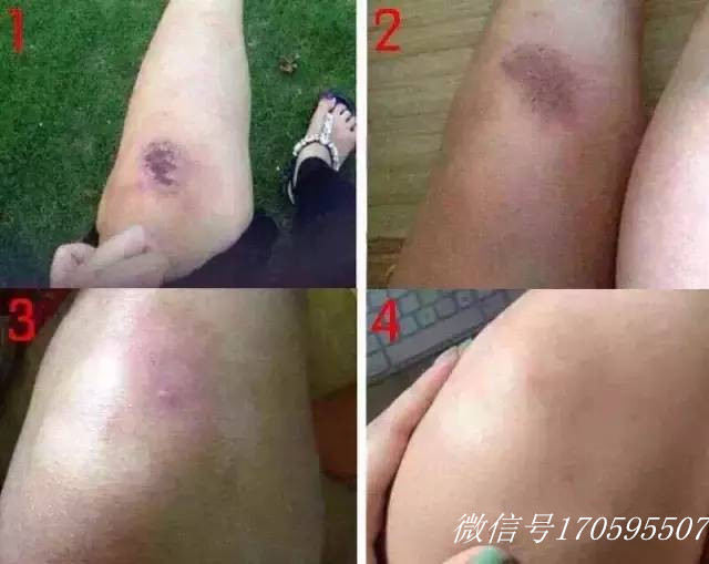 祛疤妙招—日本处方祛疤膏