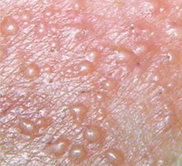 cdc性传播疾病治疗指南,std性传播疾病