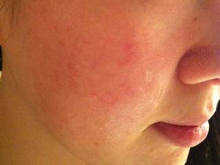 季节性过敏脸上过敏泛红起痘,如何预防季节性皮肤过敏