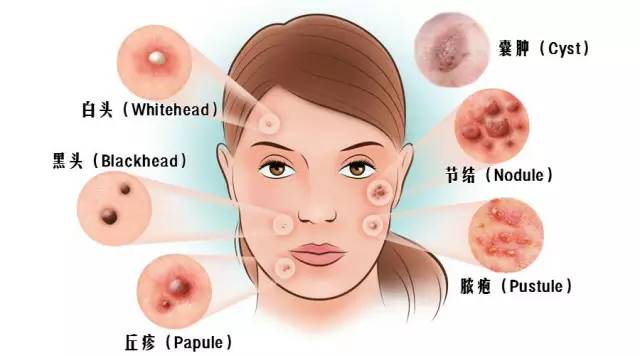 痘疮最好的治疗方法,疮痘是什么