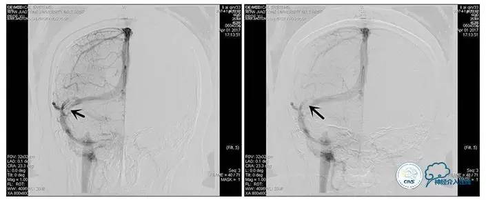 静脉窦狭窄支架植入术,静脉窦狭窄做支架多少钱