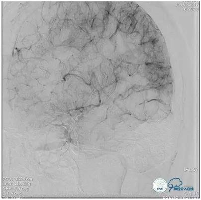 静脉窦狭窄支架植入术,静脉窦狭窄做支架多少钱