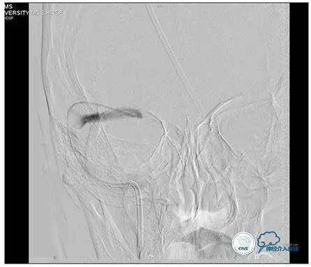 静脉窦狭窄支架植入术,静脉窦狭窄做支架多少钱