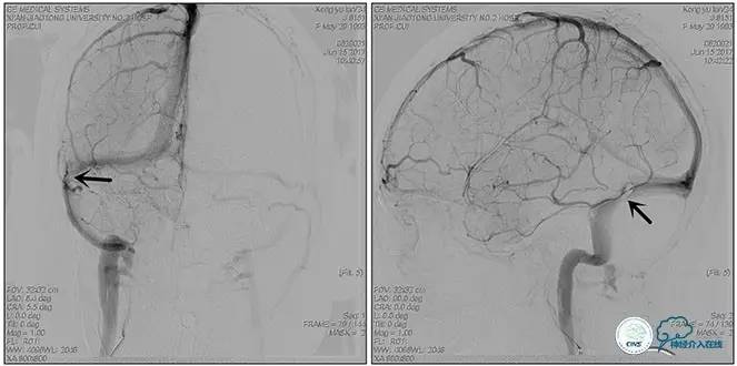 静脉窦狭窄支架植入术,静脉窦狭窄做支架多少钱