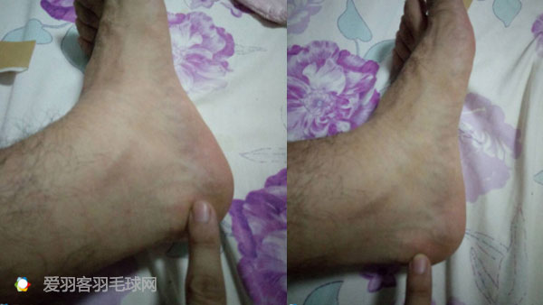 每次打完羽毛球回家脚后跟酸痛,打羽毛球后左脚脚后跟和足弓疼