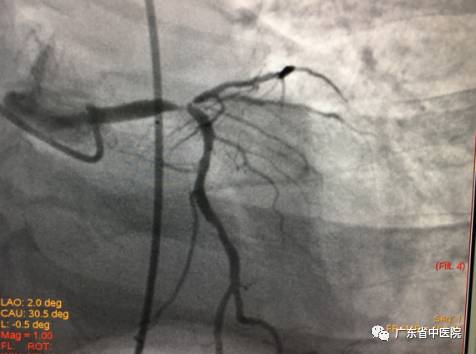 心衰患者出现短暂室颤随后恢复,心衰室颤抢救时插管救活几率高吗