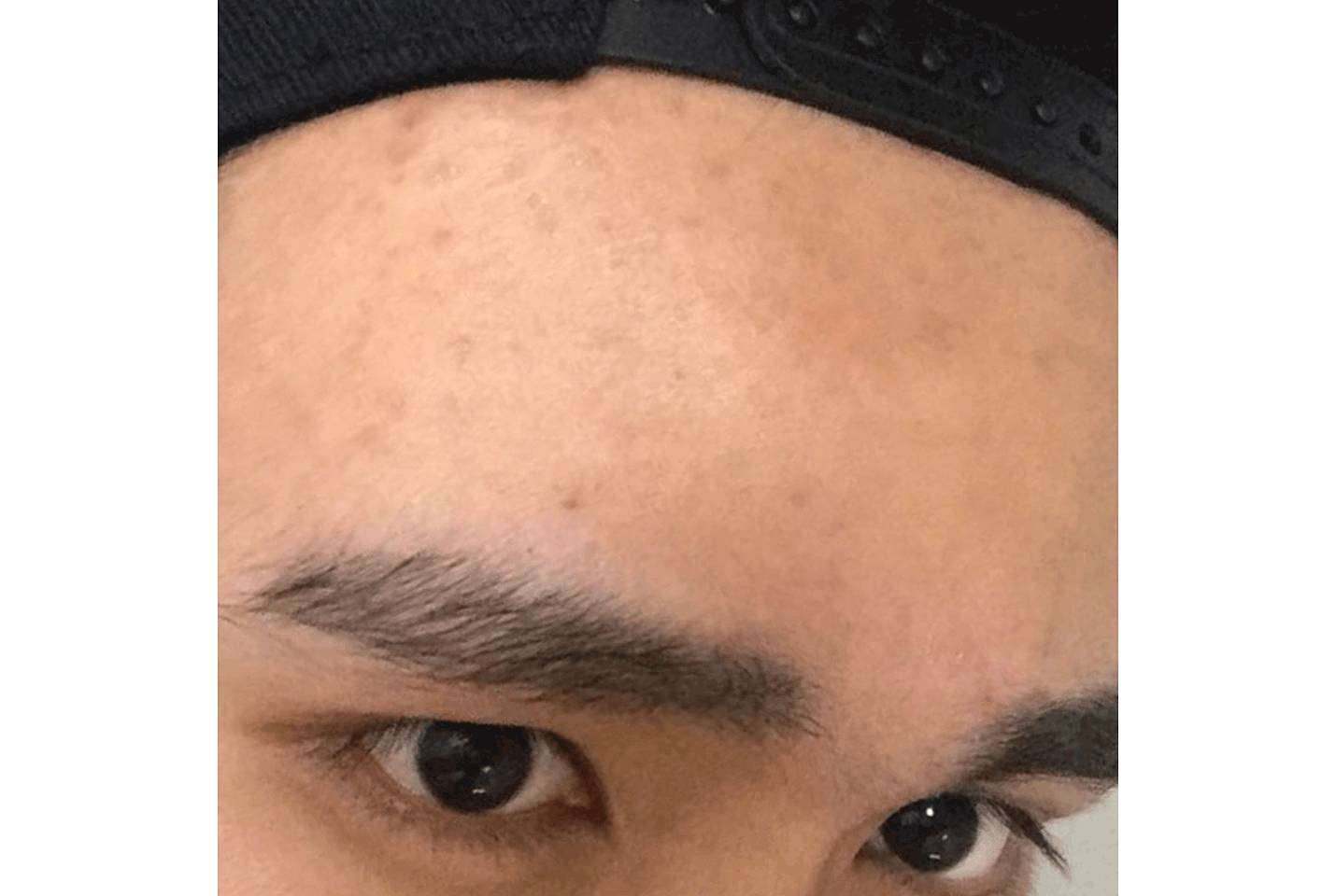 我的祛斑血泪史完整版,我的祛痘史