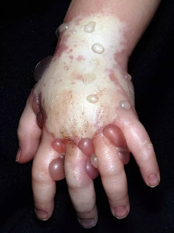 触目惊心！一例静滴药物外渗造成的严重并发症！