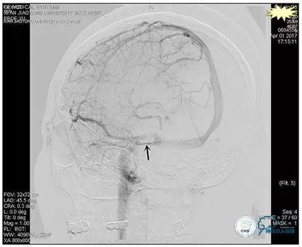 静脉窦狭窄支架植入术,静脉窦狭窄做支架多少钱