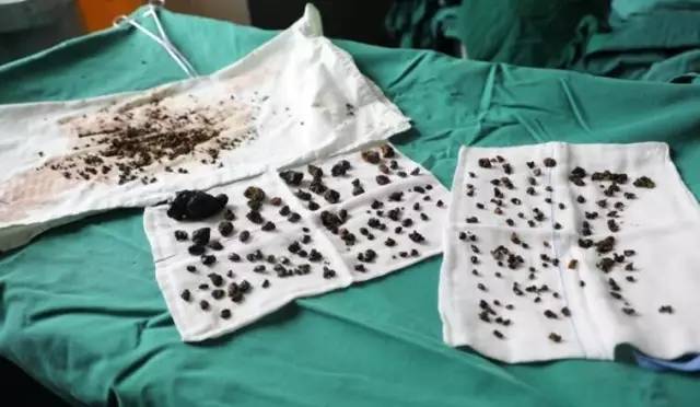 女子没吃早餐体内1000多颗结石,沈阳女子身体里取出400颗结石