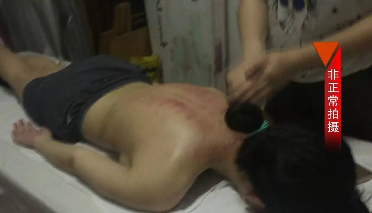 男子拔火罐被烧伤,男子拔罐被烧伤