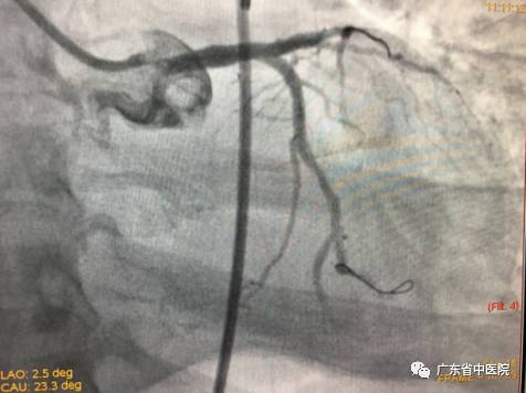 心衰患者出现短暂室颤随后恢复,心衰室颤抢救时插管救活几率高吗