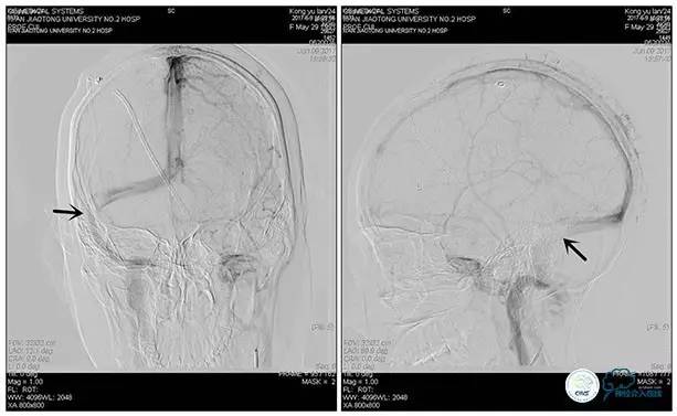静脉窦狭窄支架植入术,静脉窦狭窄做支架多少钱