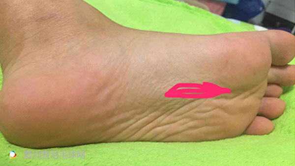 每次打完羽毛球回家脚后跟酸痛,打羽毛球后左脚脚后跟和足弓疼