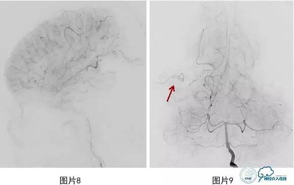 颅内动脉瘤血管内治疗的缺血性并发症