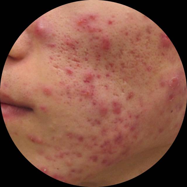 战痘｜史上最全”战痘“解答50+合集！