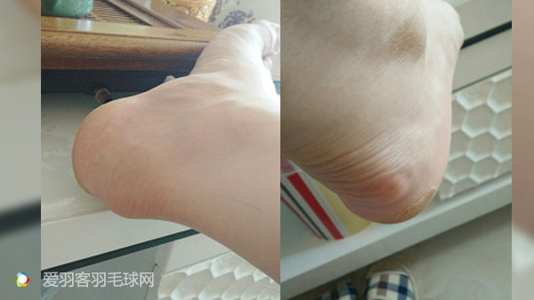 每次打完羽毛球回家脚后跟酸痛,打羽毛球后左脚脚后跟和足弓疼