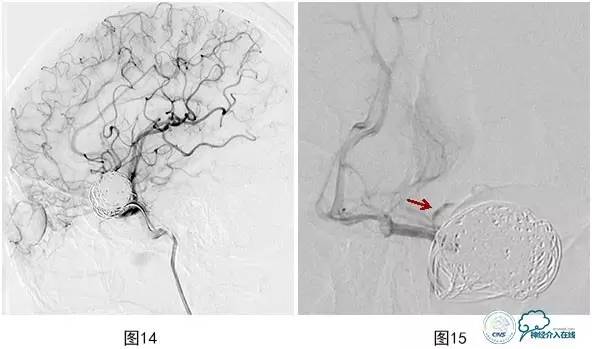 颅内动脉瘤血管内治疗的缺血性并发症