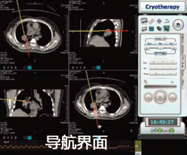 这一周，POCT领域新增一家上市公司，肿瘤NGS和液体活检领域新增一笔巨额融资