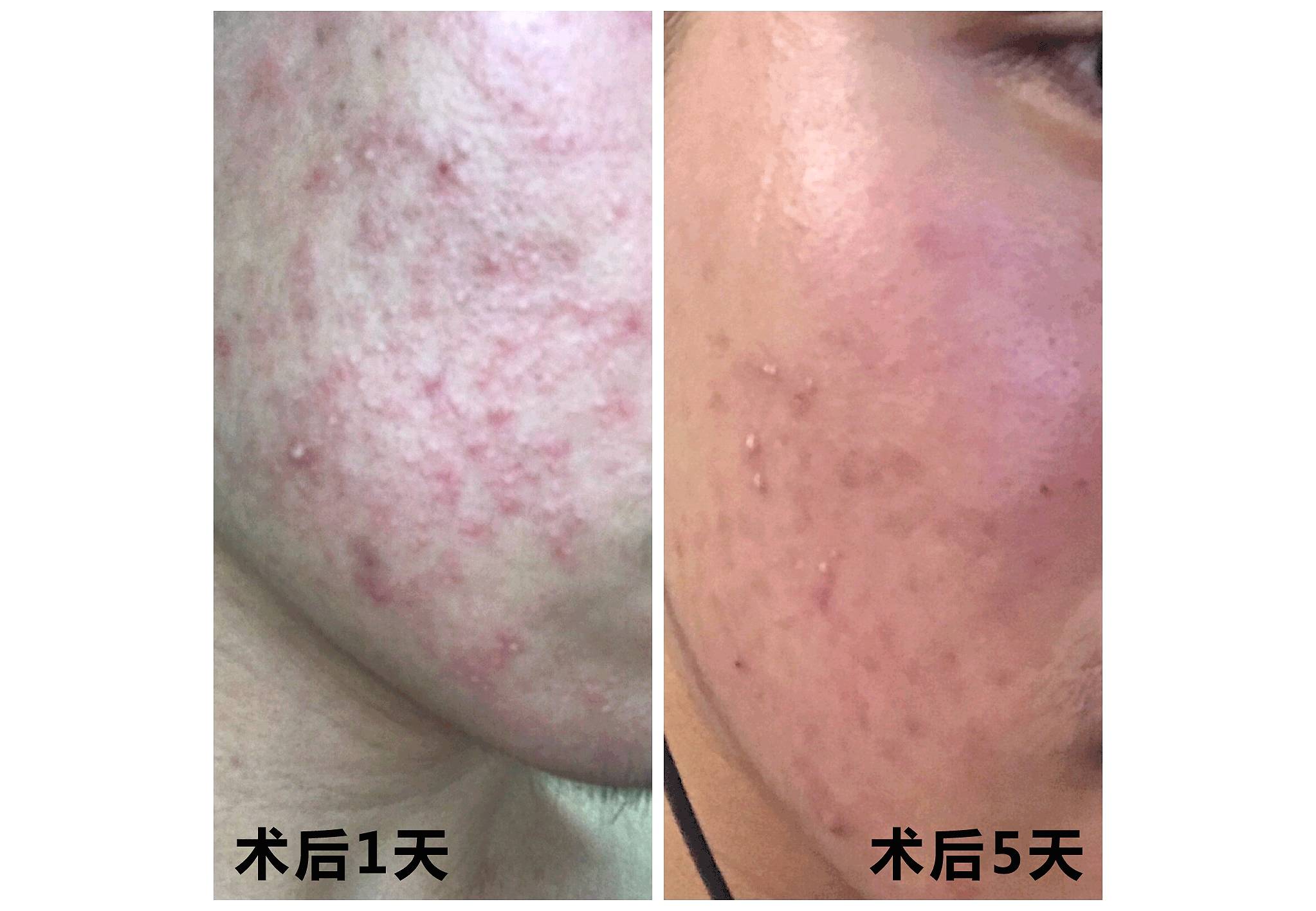 我的祛斑血泪史完整版,我的祛痘史