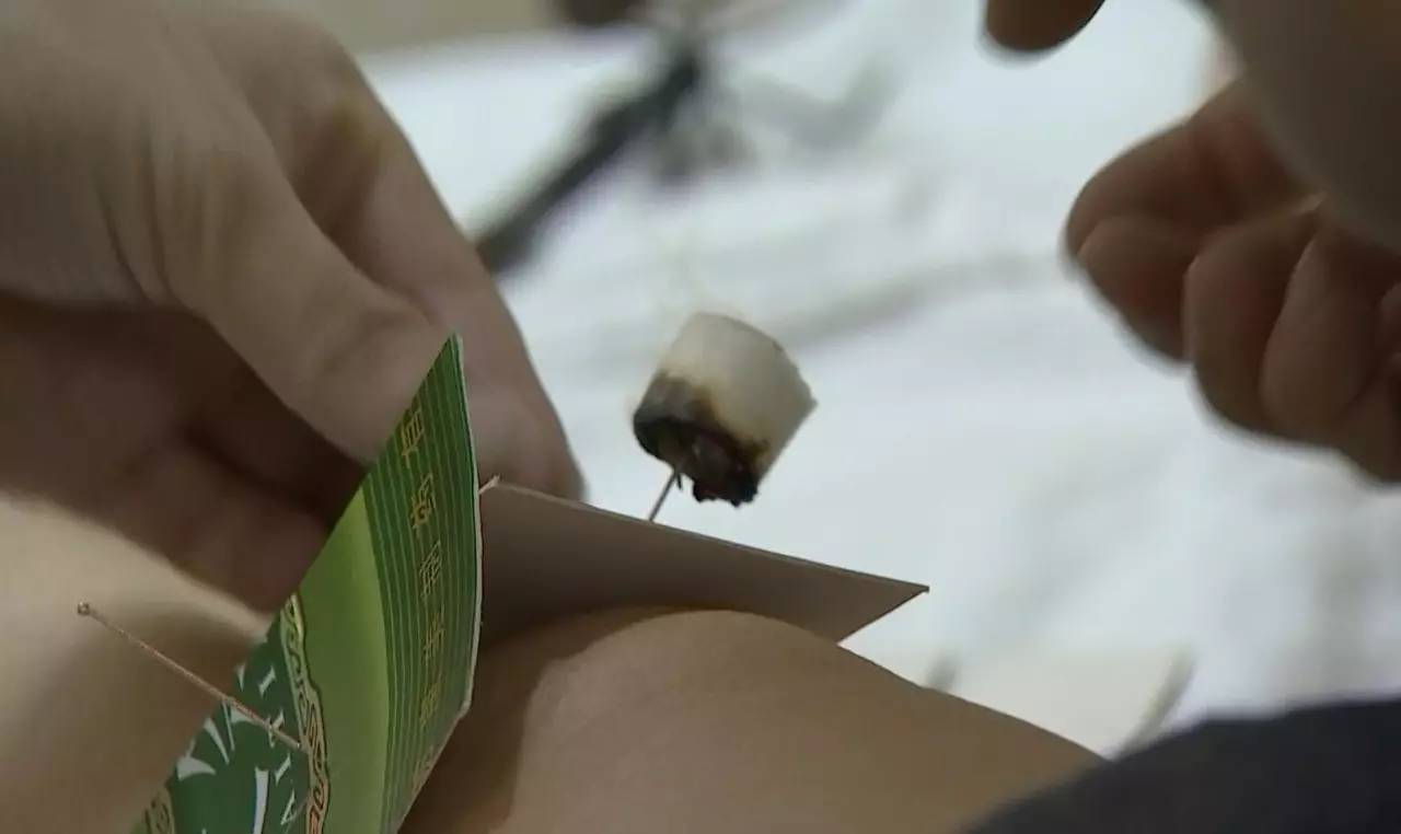 男子拔火罐被烧伤,男子拔罐被烧伤