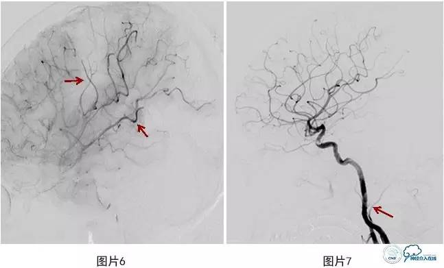 颅内动脉瘤血管内治疗的缺血性并发症