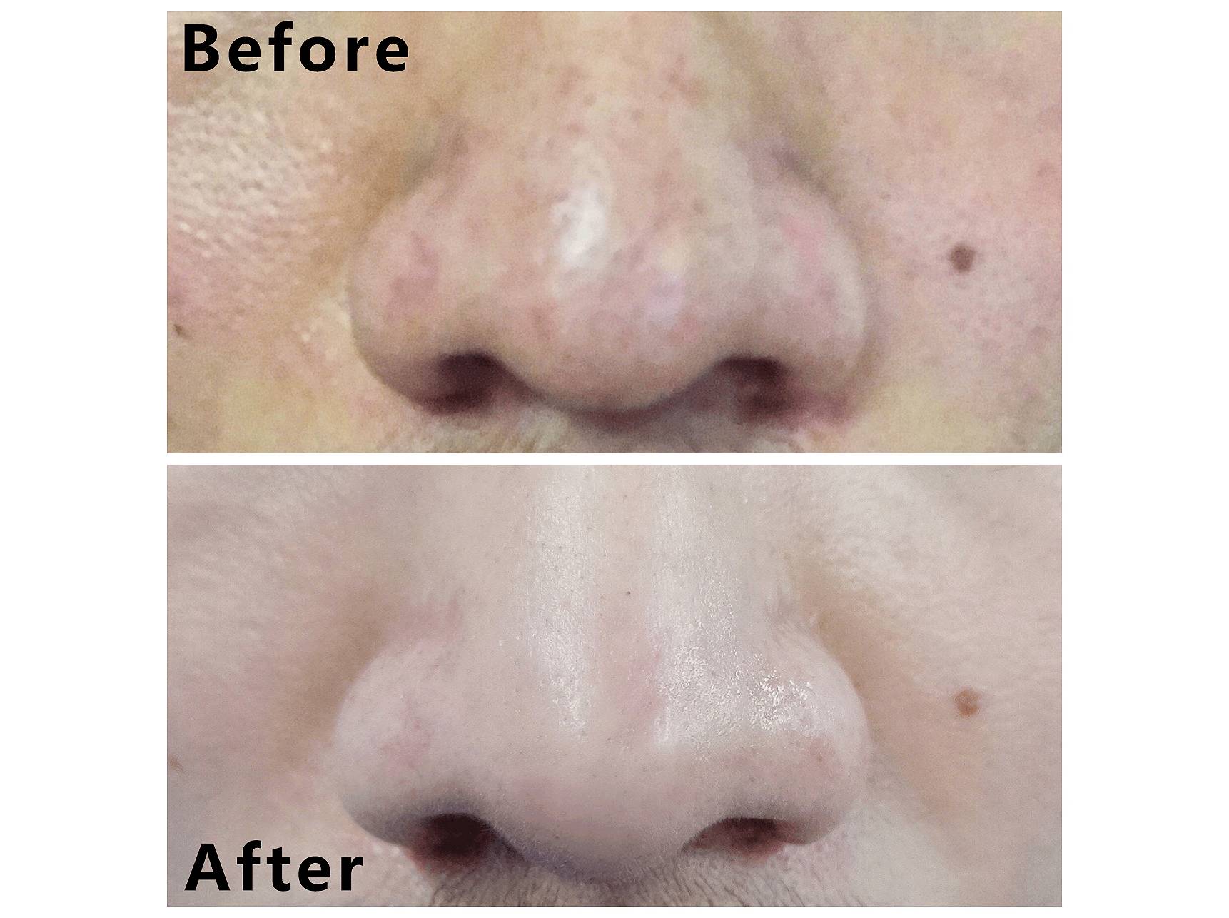 我的祛斑血泪史完整版,我的祛痘史