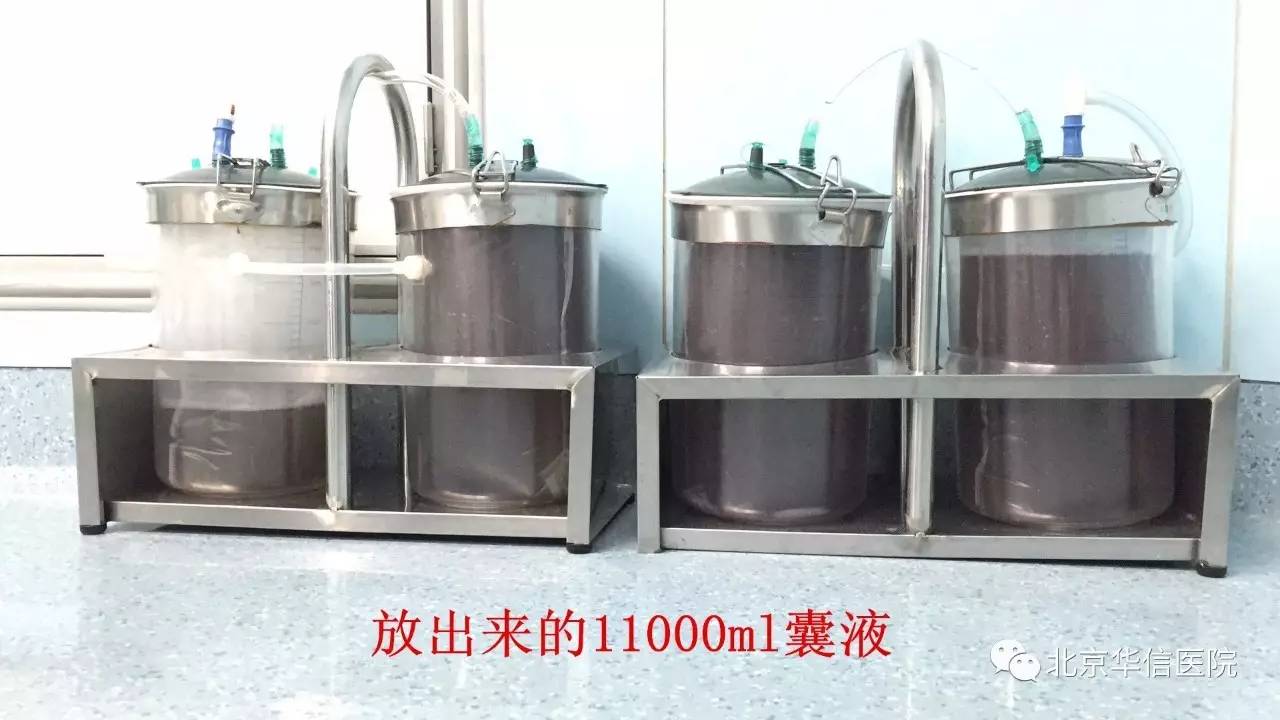 附件囊肿大于5cm一定要手术吗,附件囊肿手术是全麻还是局部麻醉