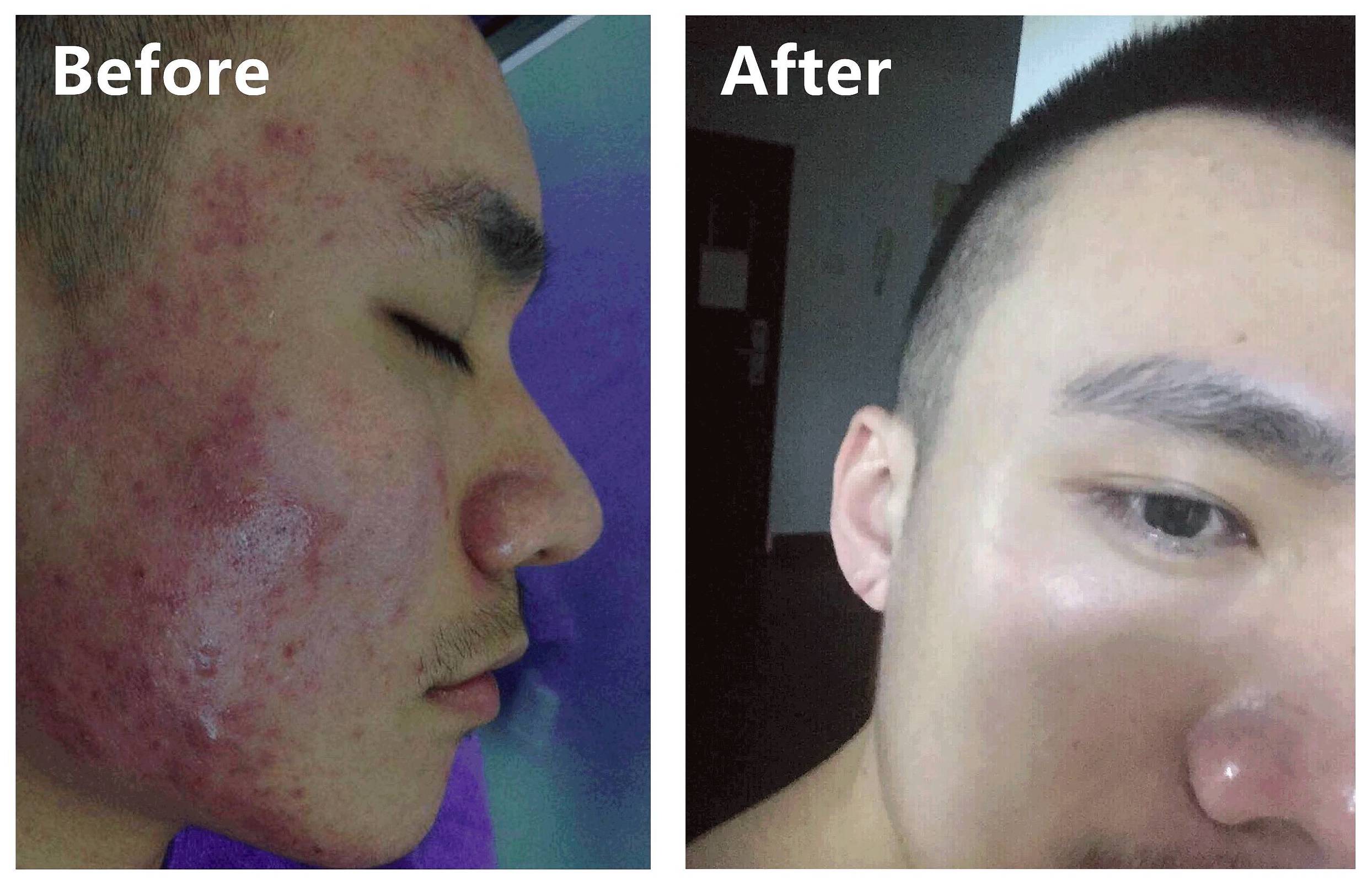 我的祛斑血泪史完整版,我的祛痘史