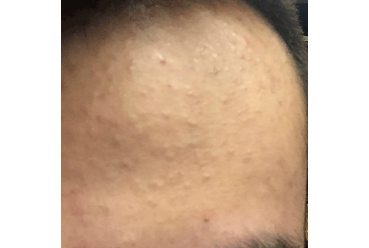 我的祛斑血泪史完整版,我的祛痘史