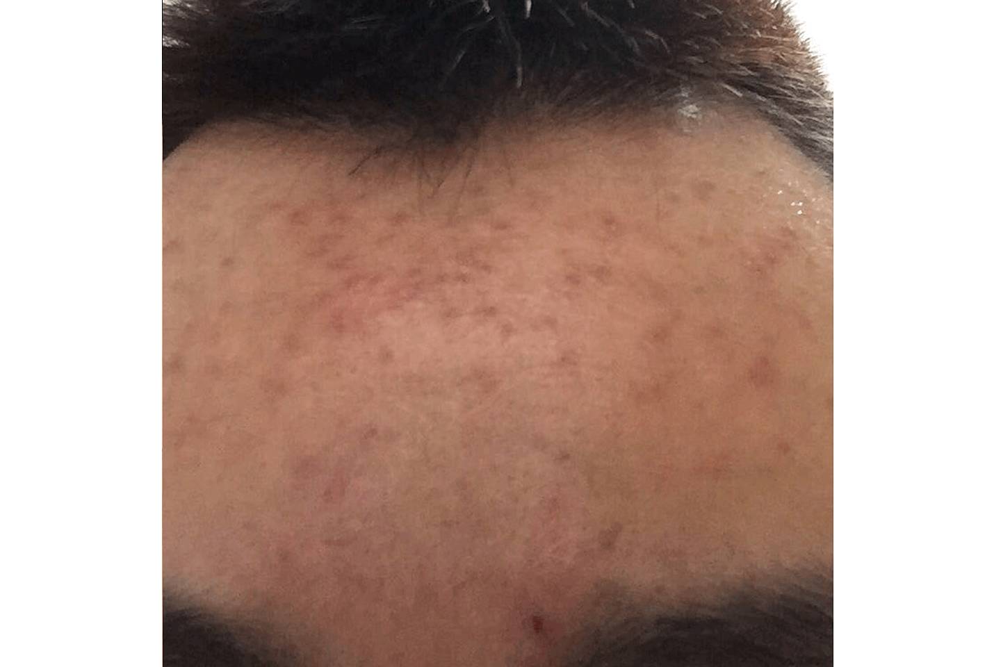 我的祛斑血泪史完整版,我的祛痘史