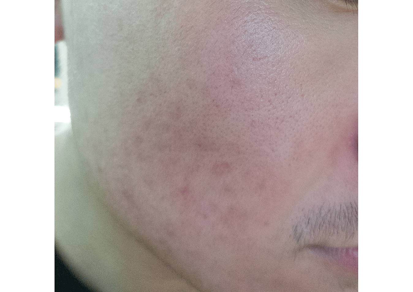 我的祛斑血泪史完整版,我的祛痘史