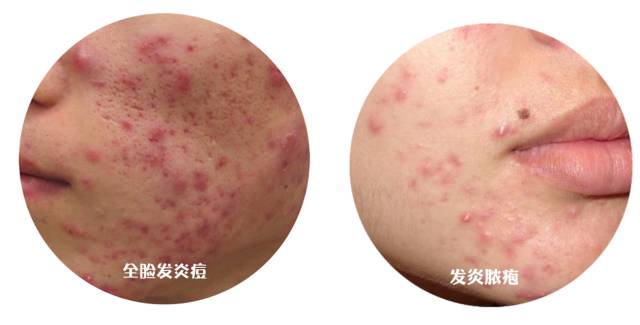 战痘｜史上最全”战痘“解答50+合集！