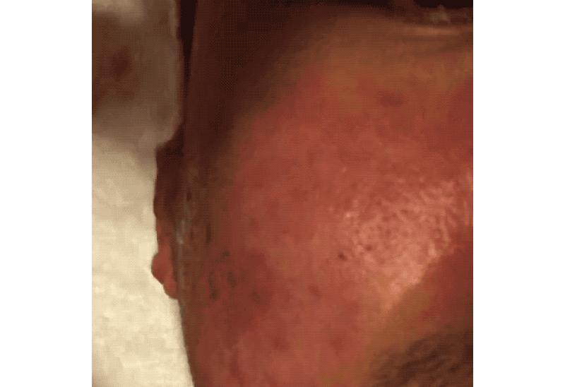 我的祛斑血泪史完整版,我的祛痘史