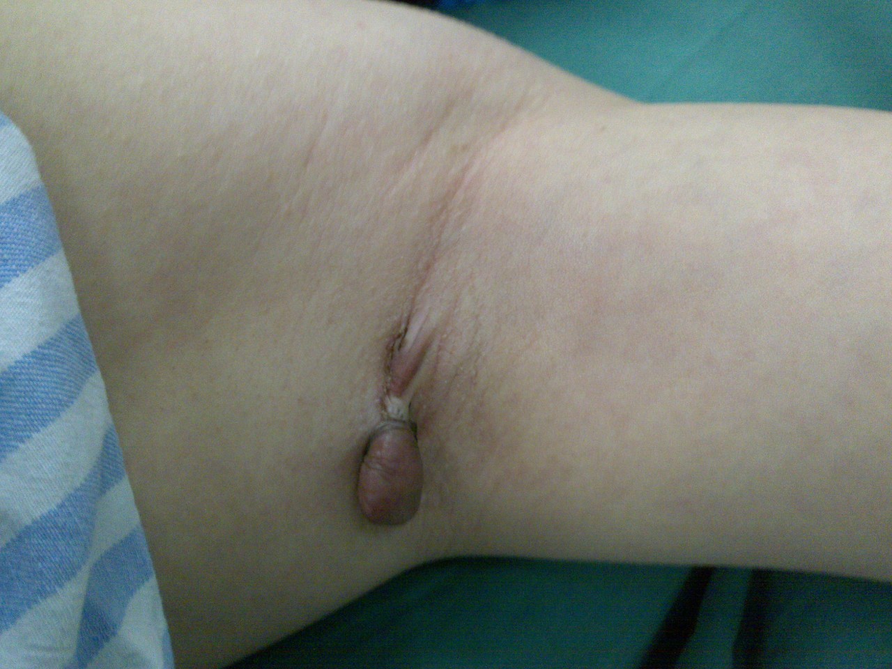 30年的手术疤痕,28年的手术疤痕